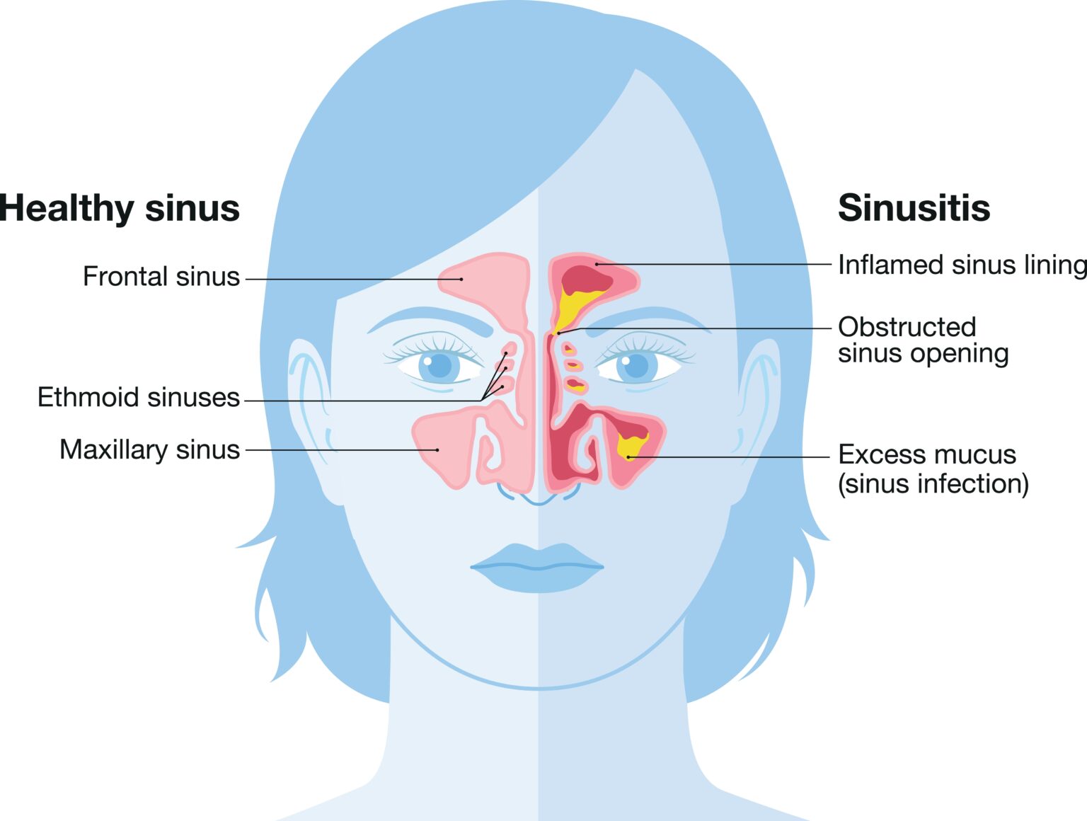 How Does Sinus Affect Your Head